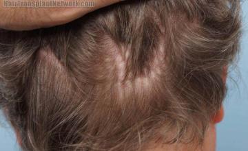 Hair replacement surgery before and after images