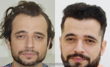 Front view - Before and after