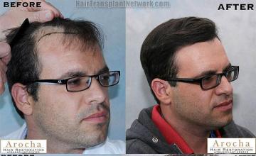  before and after images