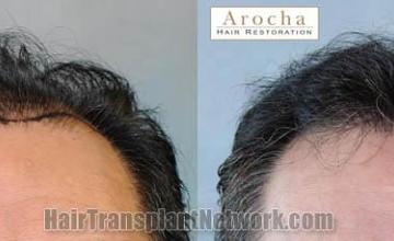 Front view - Before and after