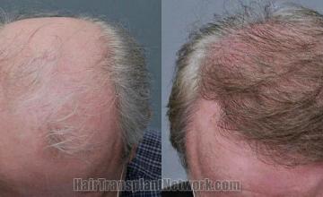 Top view - Before and after surgical hair replacement