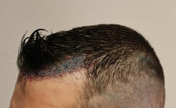 Before and after hair transplant