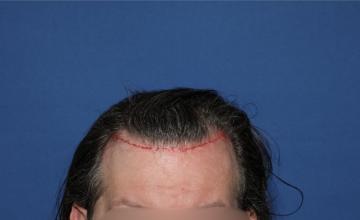 Before and After hair transplant