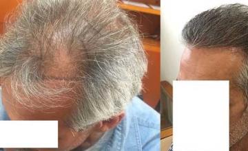 Left view before and after 2800 FUE grafts