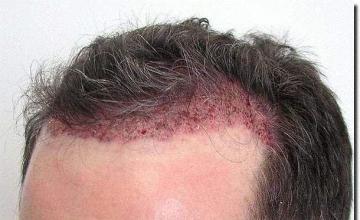 Hair restoration procedure results