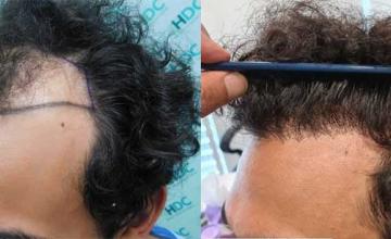 Left side of patient, before and after hair transplant