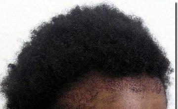 Hair restoration procedure results
