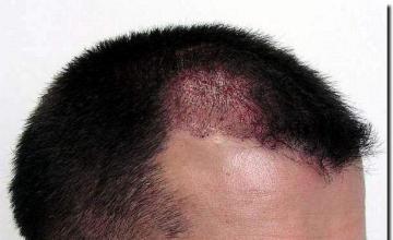 Hair restoration procedure results