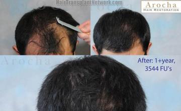 Hair transplantation surgery before and after photos