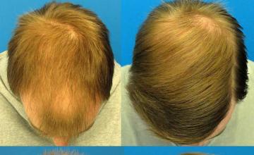 Hair transplantation surgery before and after photos