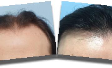 Front view - Before and after  