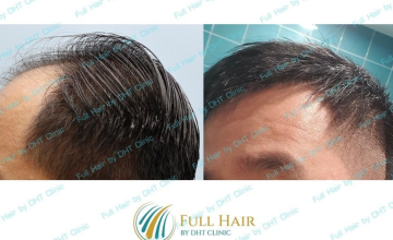 Hair Transplant Before and After